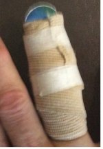 Shipboard splint.jpg Shipboard splint.jpg