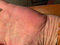 carpal tunnel scar left.jpg