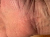 carpal tunnel scar right.jpg