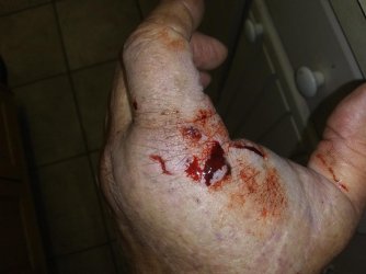 Hand injury thumlb.jpg
